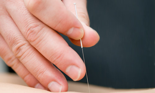 dry-needling-melbourne.jpg